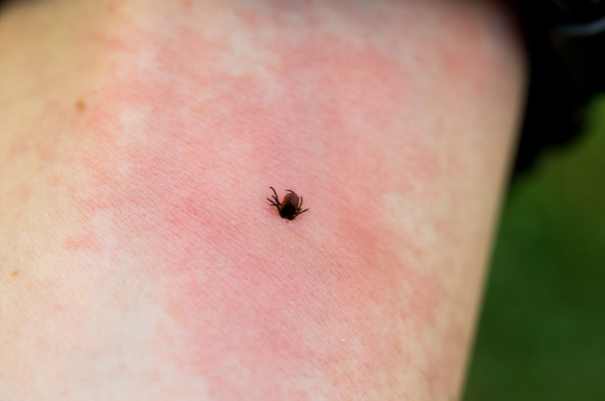 Tick with red mark on skin from DepositPhotos