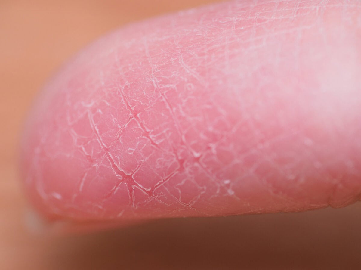 Painful broken finger skin during winter without taking good skincare under macro view.
