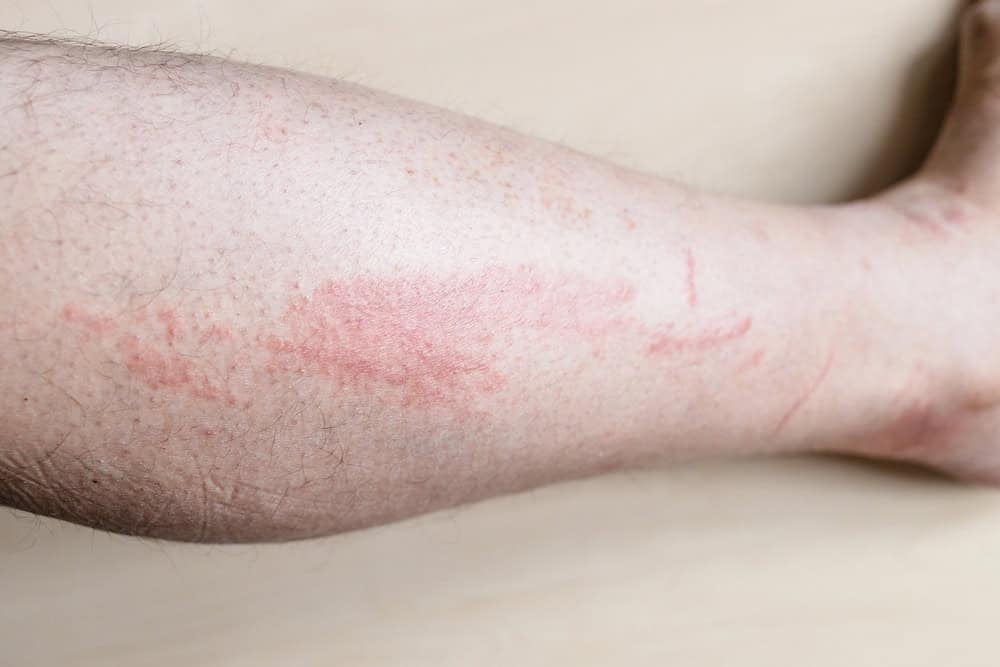 Skin redness dur to jellyfish sting.