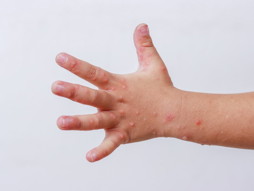 Measles