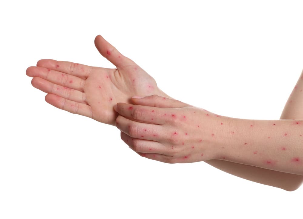 Smallpox