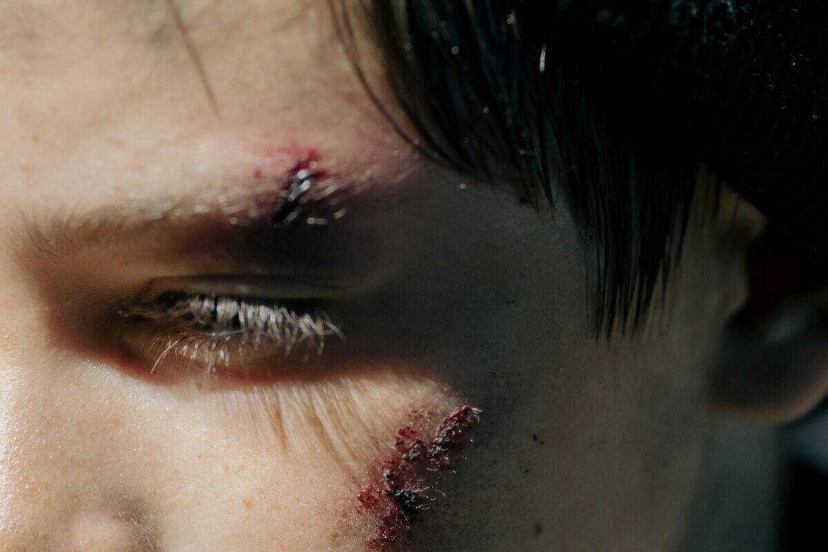 A young man with wounds on his face.